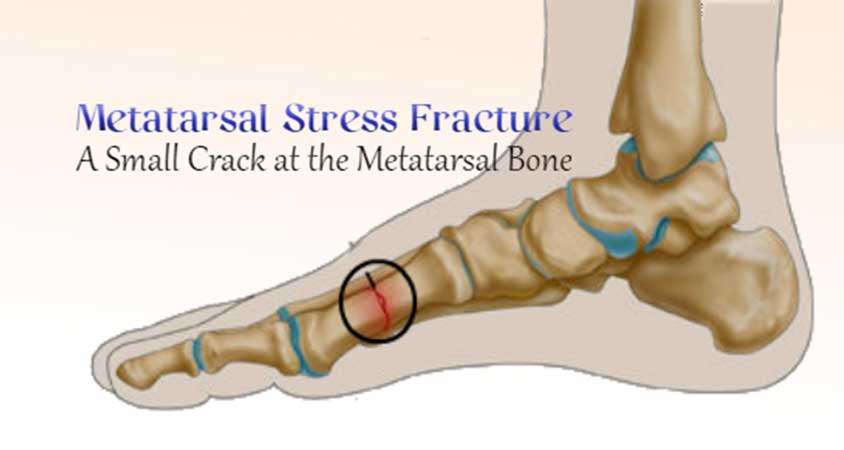 روش های درمانی، ترمیم و پیشگیری شکستگی استرسی پا