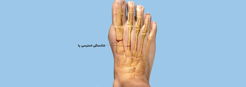 مکانیسم و محل رخ دادن آسیب شکستگی های استرسی پا
