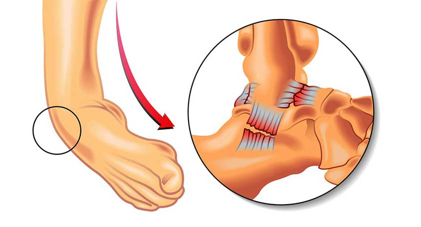 علل و ریسک فاکتورهای پیچ خوردگی و کشیدگی عضلات مچ پا