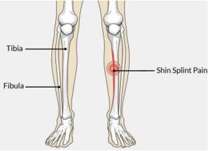 شین اسپلینت ( سندروم استرس تیبیال میانی )