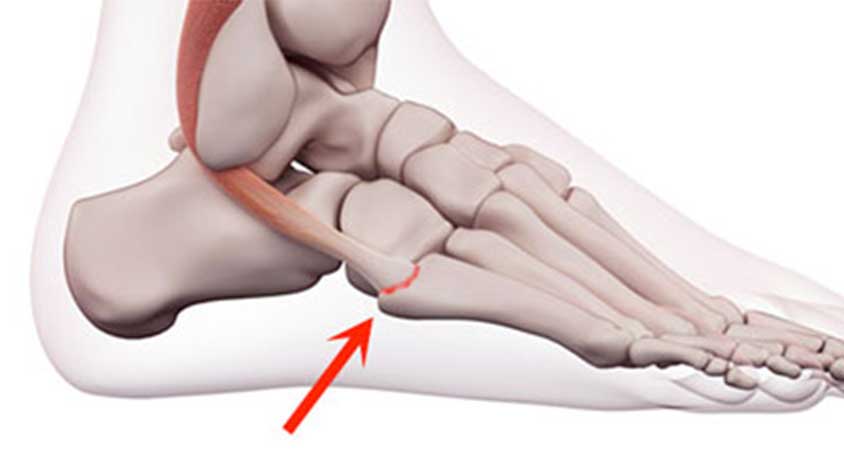 ریسک فاکتورهای شکستگی استرسی پا