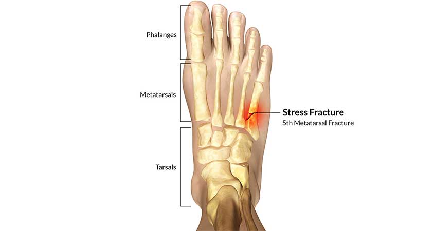 علل و ریسک فاکتورهای ایجاد شکستگی استرسی پا