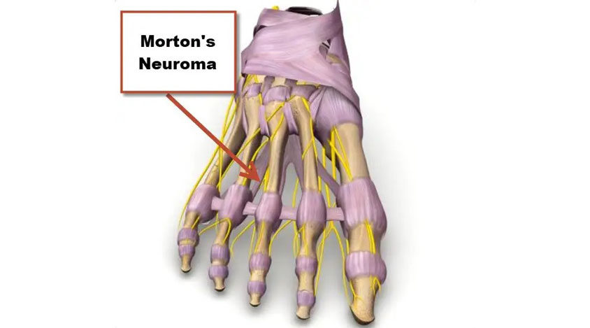 مورتون نوروما (درد، گزگز و سوزش کف پا)